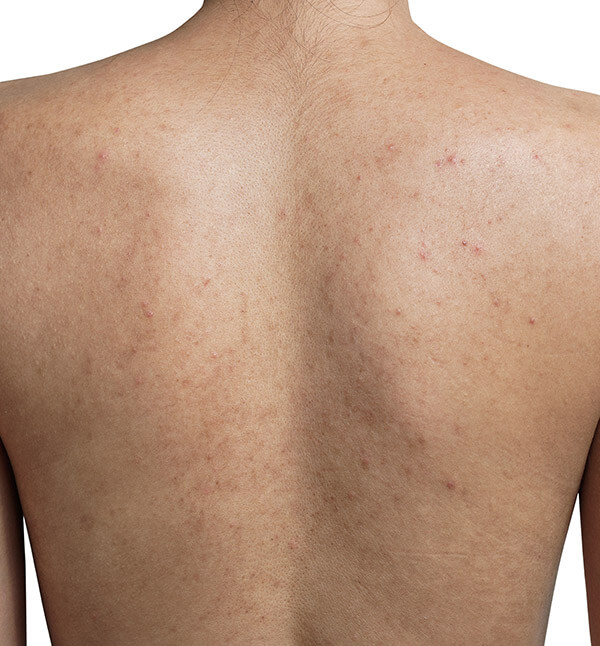 Before-back