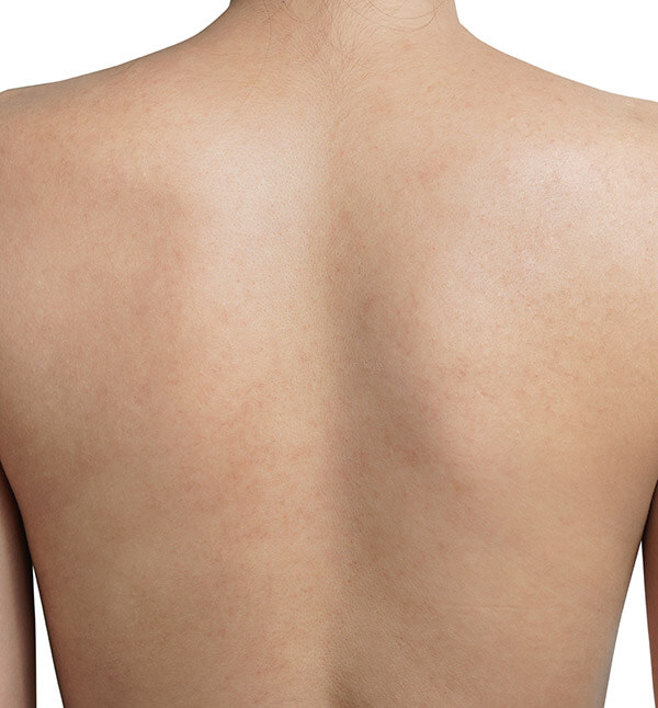 After-back